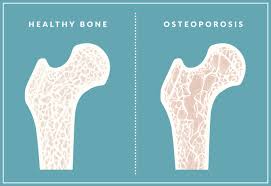 Osteoporosis treatment medications